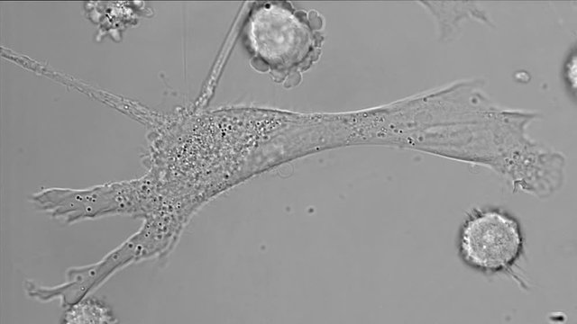 Disruption of microfilaments in PC-3 human prostate cancer cell in culture.
