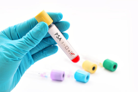 Blood sample with PSA (Prostate-specific antigen) positive
