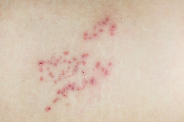 Fototapeta premium Raised red bumps and blisters on skin