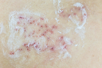 Raised red bumps and blisters on skin