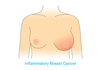 Woman's breasts change in size when has infections breast cancer.