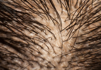 Dandruff on scalp and dark hair. Macro shot - obrazy, fototapety, plakaty