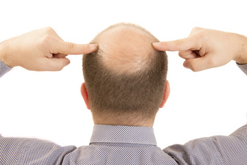 man alopecia baldness hair loss isolated