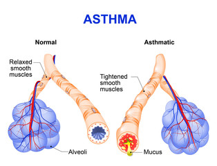 inflamation of the bronchus causing asthma