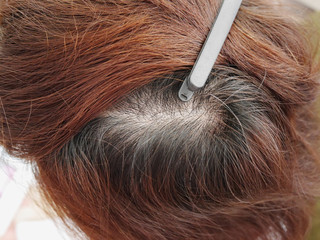 Closeup head with thinning hair, hair loss