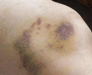 Bruises on woman leg
