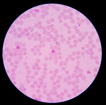 blood films for Malaria parasite.showing pink cells malaria pigm