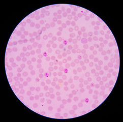 blood films for Malaria parasite.showing pink cells malaria pigm