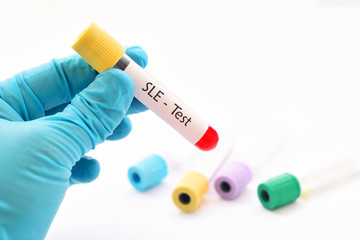Fototapeta premium Blood sample for systemic lupus erythematosus (SLE) test