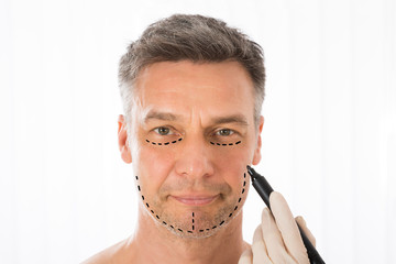 Surgeon Drawing Correction Lines On Man Face