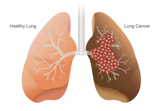 Comparison between healthy lung and cancer lung isolated on white background.