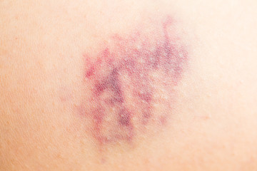 Bruise on wounded woman skin