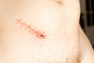 Fototapeta premium Closeup of unhealed appendix surgery scar