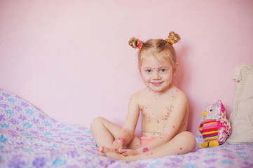 baby sitting on bed with chicken pox rash, natural photo