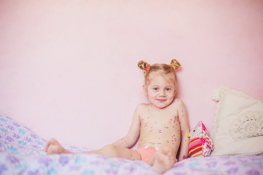 baby sitting on bed with  chicken pox rash, natural photo