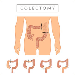 Types of colectomy - obrazy, fototapety, plakaty
