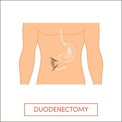 Duodenectomy vector