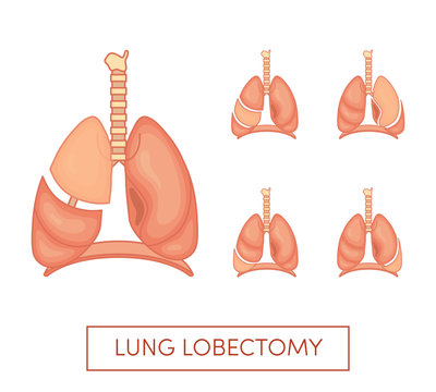 Lung Lobectomy Vector