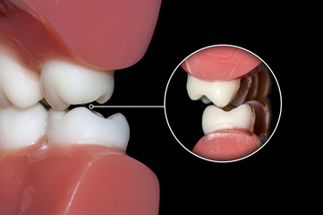 dental occlusion molars teeth close up - obrazy, fototapety, plakaty