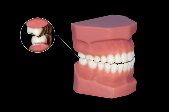 gnashing of teeth dental molars callout