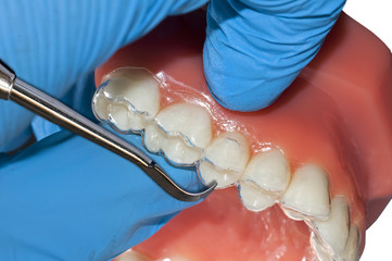 Fototapeta na wymiar dentist show invisible dental braces orthodontic aligner