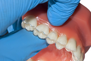 dentist show invisible braces removable orthodontic 