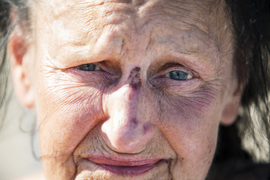Portrait of senior woman with bruises on her nose