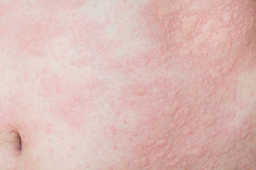 rashes in skin