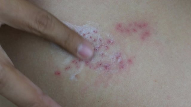 Raised red bumps and blisters on skin with white cream selective focus on finger