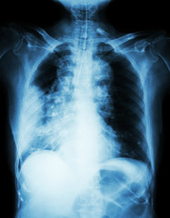 Lung cancer .  Film chest x-ray show right lung mass , wide mediastinum , pneumonia and right pleural effusion