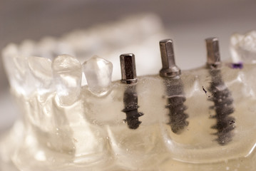 Primo piano di un impianto dentale