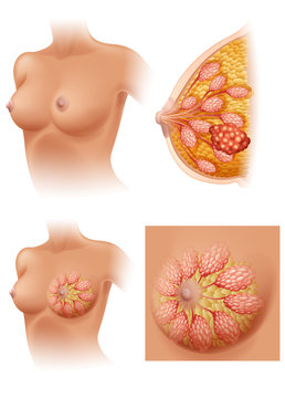 Diagram of woman having breast cancer