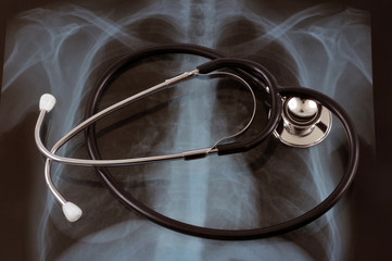 Stéthoscope posé sur une radio des poumons