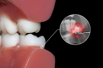 dental toothache, wisdom tooth and molar impact