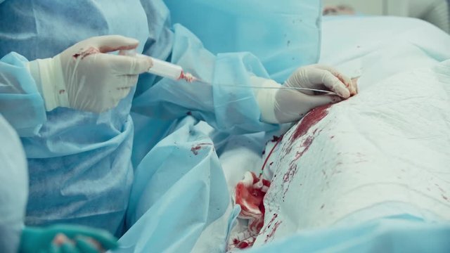 Surgeon performing coronary artery bypass grafting assisted by nurse, shot on Sony NEX 700 + Odyssey 7Q