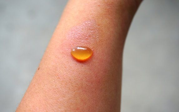 Blister on skin,  a small pocket of fluid within the upper layers of the skin