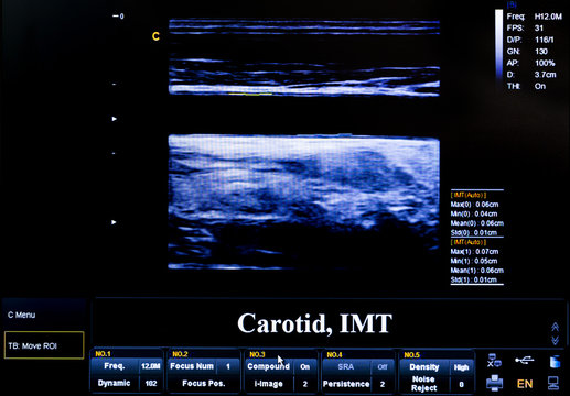 Colourful ultrasound monitor image. Carotid artery