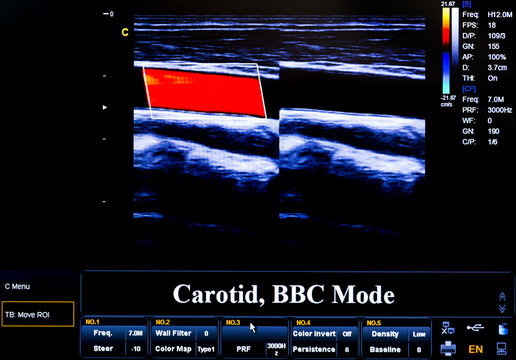 Colourful ultrasound monitor image. Carotid artery