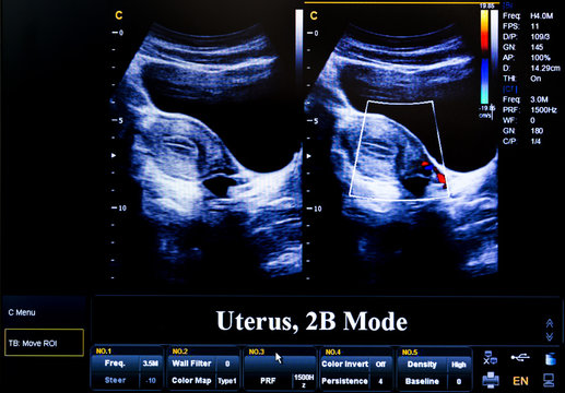 Colourful ultrasound monitor image. Uterus 2D