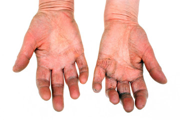 Arthritic old hands