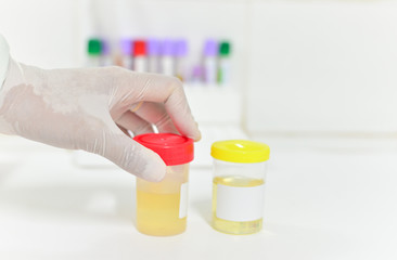 hand with urine container