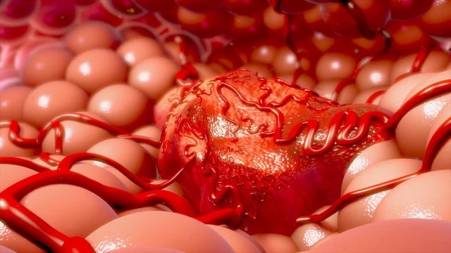 Tumour