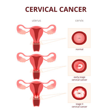 cervical cancer schematic illustration