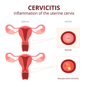 cervicitis schematic illustration