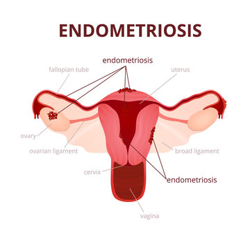 Endometriosis in the uterus
