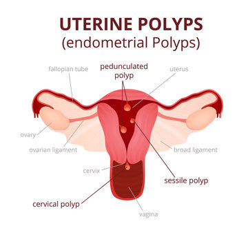 classification of uterine polyps
