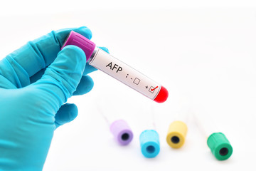 Fototapeta premium AFP positive, liver cancer diagnosis