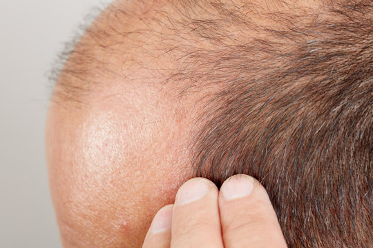 Hair loss.