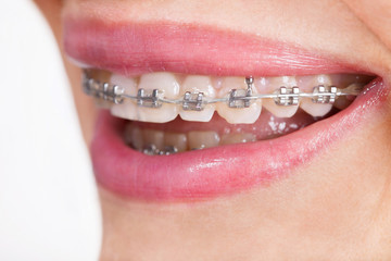 woman with teeth braces