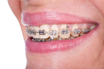 teeth with braces, close up